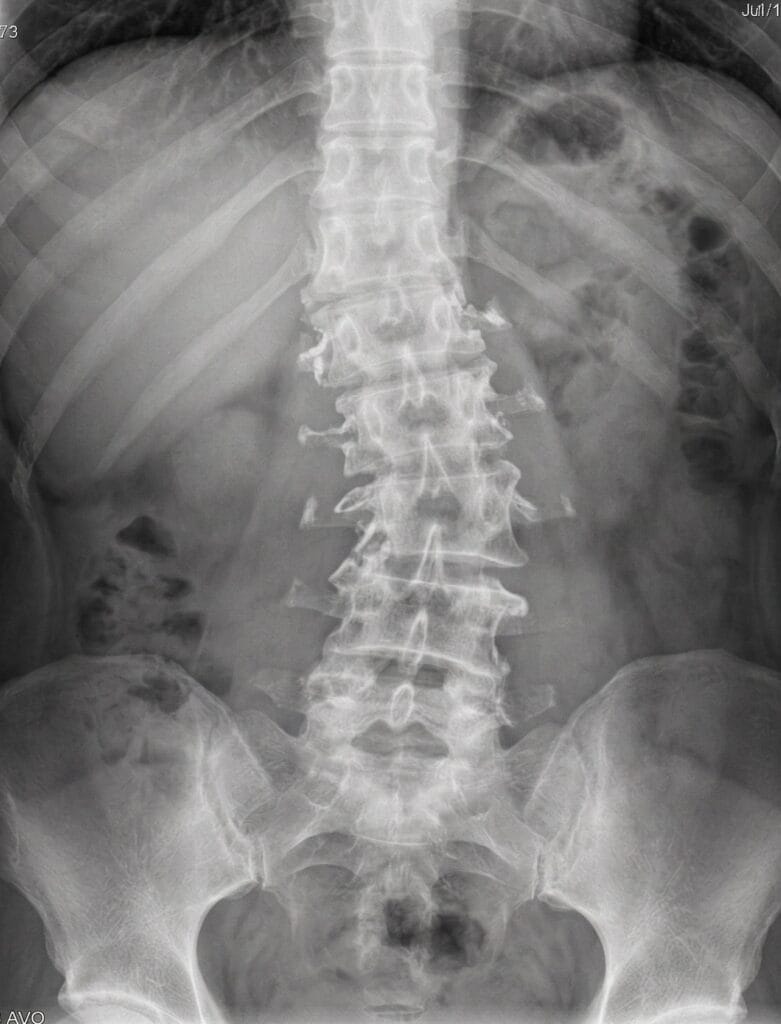 Adult Scoliosis Treatment: Can You Straighten a Curved Spine After Puberty? degenerative scoliosis